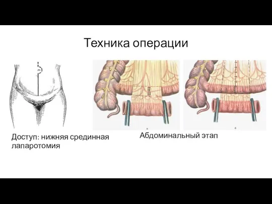 Техника операции Доступ: нижняя срединная лапаротомия Абдоминальный этап