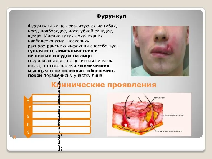 Х Фурункул Фурункулы чаще локализуются на губах, носу, подбородке, носогубной складке, щеках.