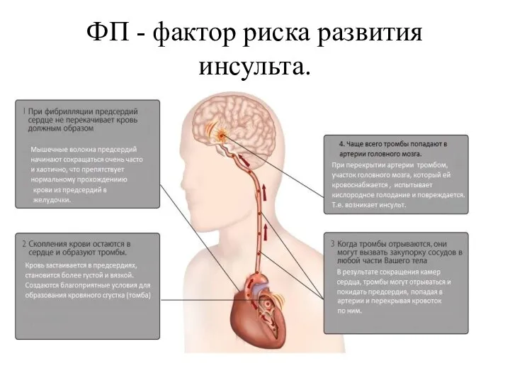 ФП - фактор риска развития инсульта.