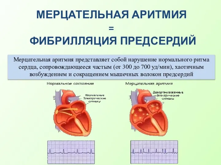 МЕРЦАТЕЛЬНАЯ АРИТМИЯ = ФИБРИЛЛЯЦИЯ ПРЕДСЕРДИЙ Мерцательная аритмия представляет собой нарушение нормального ритма