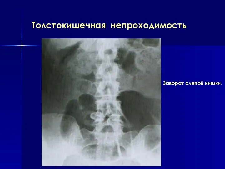 Толстокишечная непроходимость Заворот слепой кишки.