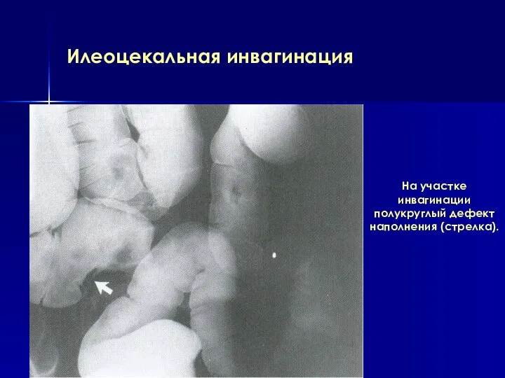 Илеоцекальная инвагинация На участке инвагинации полукруглый дефект наполнения (стрелка).