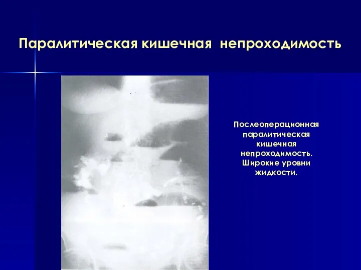 Паралитическая кишечная непроходимость Послеоперационная паралитическая кишечная непроходимость. Широкие уровни жидкости.