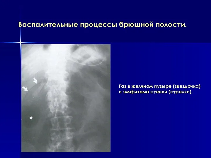 Воспалительные процессы брюшной полости. Газ в желчном пузыре (звездочка) и эмфизема стенки (стрелки).