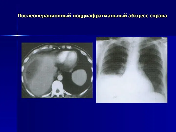 Послеоперационный поддиафрагмальный абсцесс справа