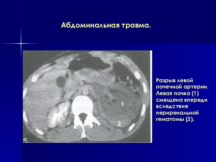 Абдоминальная травма. Разрыв левой почечной артерии. Левая почка (1) смещена кпереди вследствие периренальной гематомы (2).