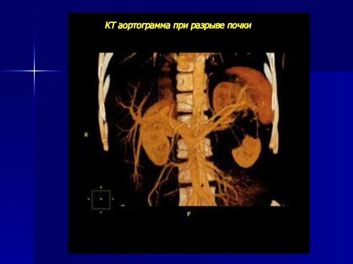 КТ аортограмма при разрыве почки