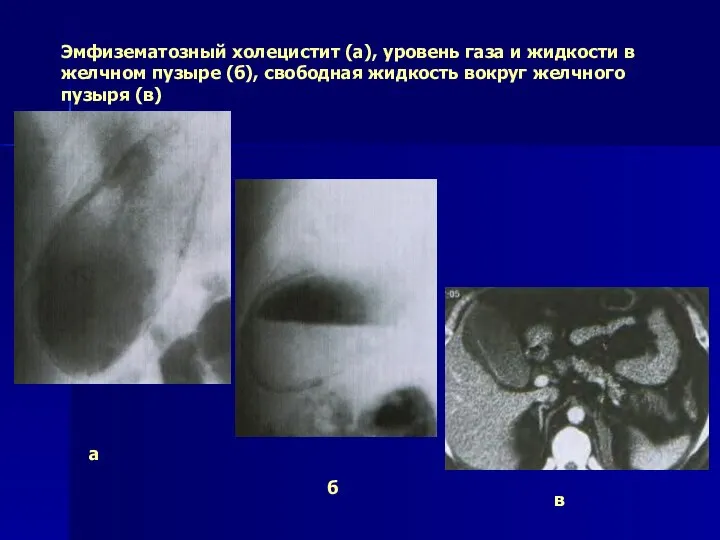 Эмфизематозный холецистит (а), уровень газа и жидкости в желчном пузыре (б), свободная