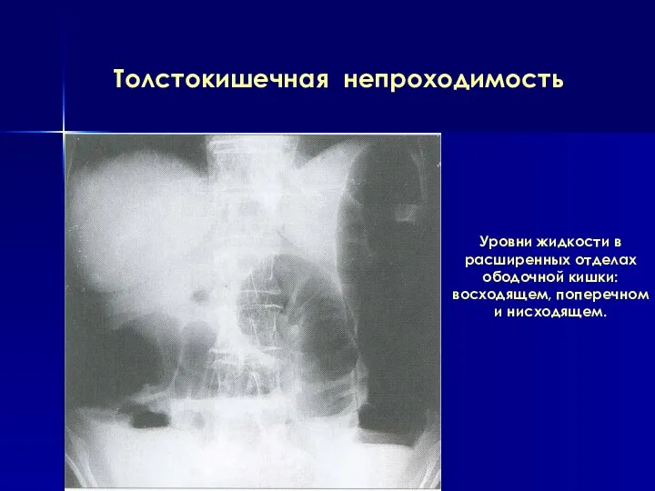 Толстокишечная непроходимость Уровни жидкости в расширенных отделах ободочной кишки: восходящем, поперечном и нисходящем.