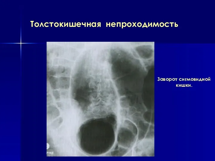 Толстокишечная непроходимость Заворот сигмовидной кишки.