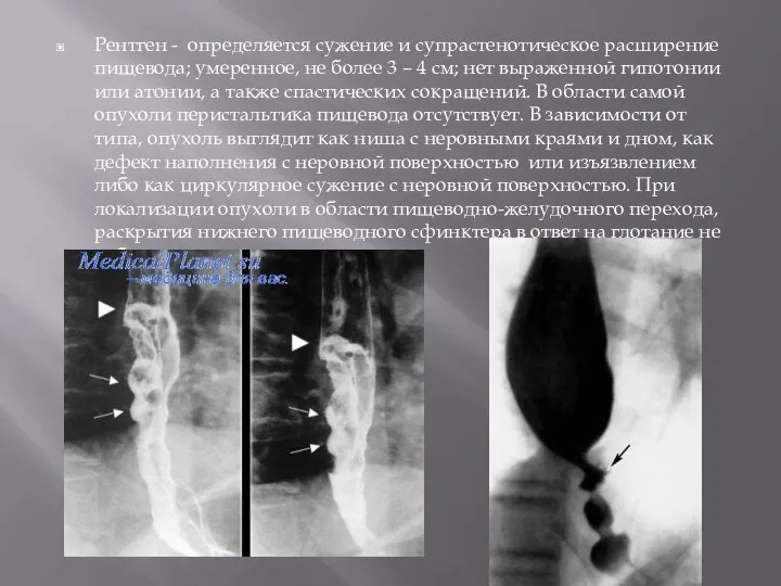 Рентген - определяется сужение и супрастенотическое расширение пищевода; умеренное, не более 3