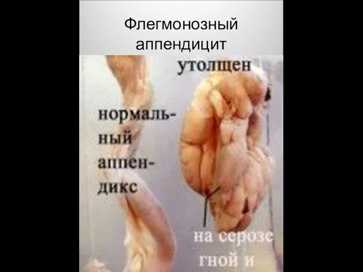 Флегмонозный аппендицит