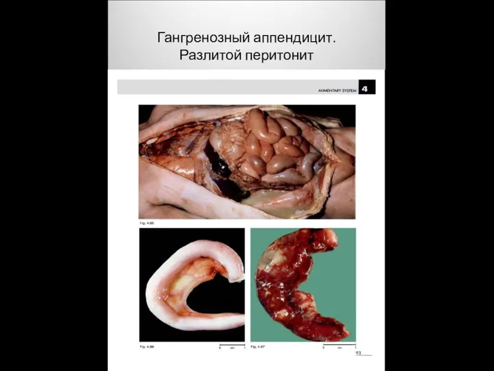 Гангренозный аппендицит. Разлитой перитонит