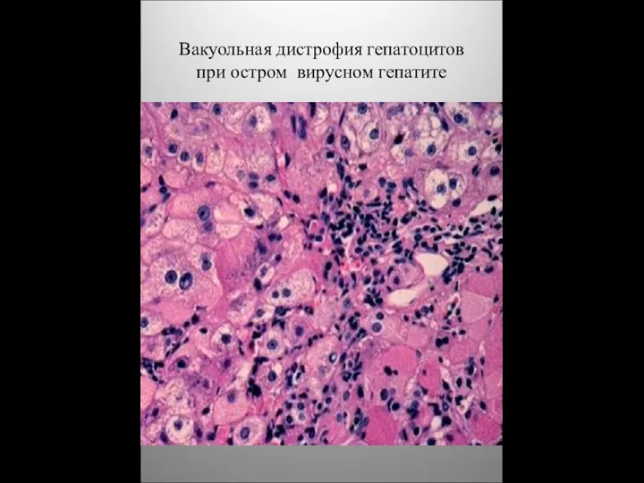 Вакуольная дистрофия гепатоцитов при остром вирусном гепатите