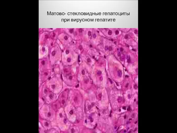 Матово- стекловидные гепатоциты при вирусном гепатите