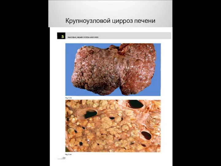 Крупноузловой цирроз печени