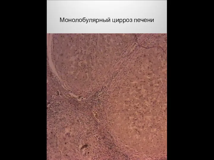 Монолобулярный цирроз печени