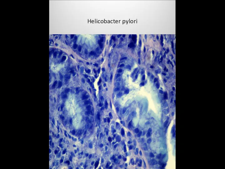 Helicobacter pylori