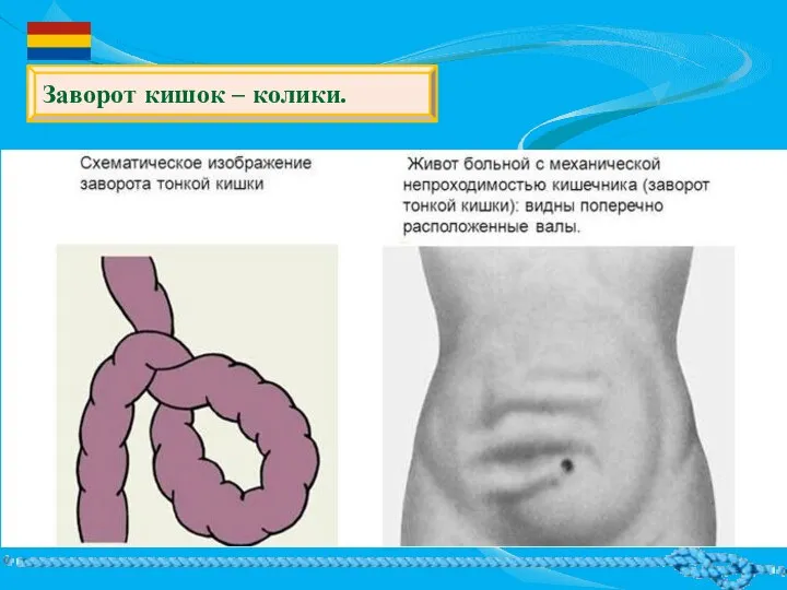 Заворот кишок – колики.