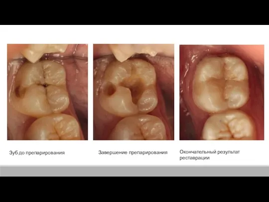 Зуб до препарирования Завершение препарирования Окончательный результат реставрации