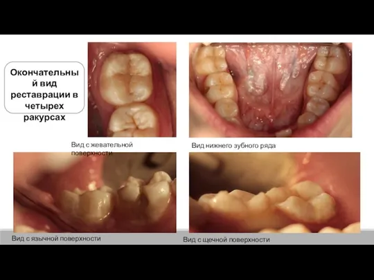 Вид с жевательной поверхности Вид с щечной поверхности Окончательный вид реставрации в