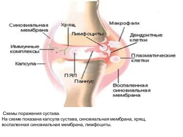 Схемы поражения сустава. На схеме показана капсула сустава, синовиальная мембрана, хрящ, воспаленная синовиальная мембрана, лимфоциты.