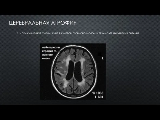 ЦЕРЕБРАЛЬНАЯ АТРОФИЯ - прижизненное уменьшение размеров гловного мозга, в результате нарушения питания