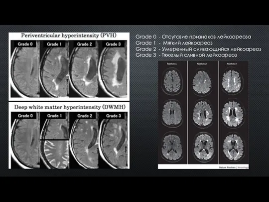 Grade 0 - Отсутсвие признаков лейкоареоза Grade 1 - Мягкий лейкоареоз Grade