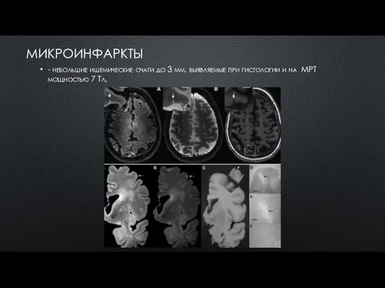 МИКРОИНФАРКТЫ - небольшие ишемические очаги до 3 мм, выявляемые при гистологии и