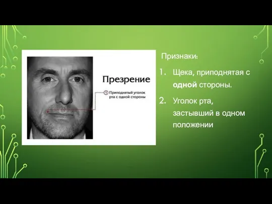 Признаки: Щека, приподнятая с одной стороны. Уголок рта, застывший в одном положении