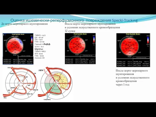 Оценка ишемически-реперфузионного повреждения Speckl-Tracking До аорто-коронарного шунтирования После аорто-коронарного шунтирования в условиях