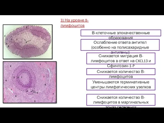 3) На уровне B-лимфоцитов В-клеточные злокачественные образования Ослабление ответа антител (особенно на