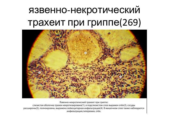 язвенно-некротический трахеит при гриппе(269)