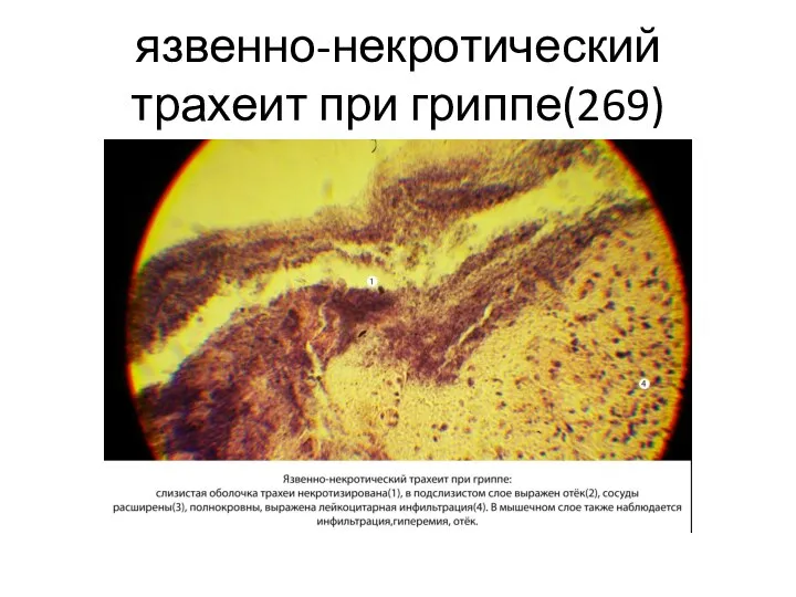 язвенно-некротический трахеит при гриппе(269)