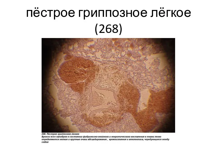 пёстрое гриппозное лёгкое(268)