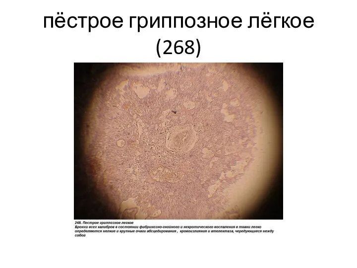 пёстрое гриппозное лёгкое(268)