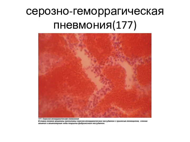 серозно-геморрагическая пневмония(177)