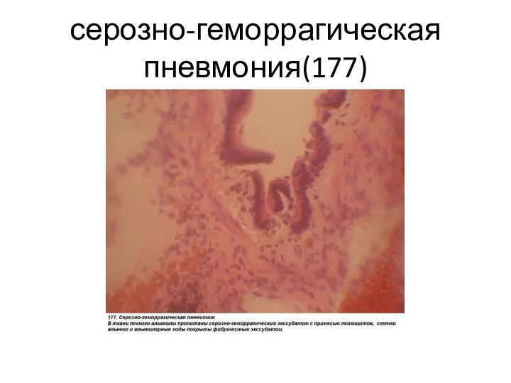 серозно-геморрагическая пневмония(177)