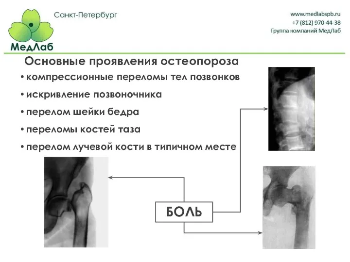 Основные проявления остеопороза компрессионные переломы тел позвонков искривление позвоночника перелом шейки бедра