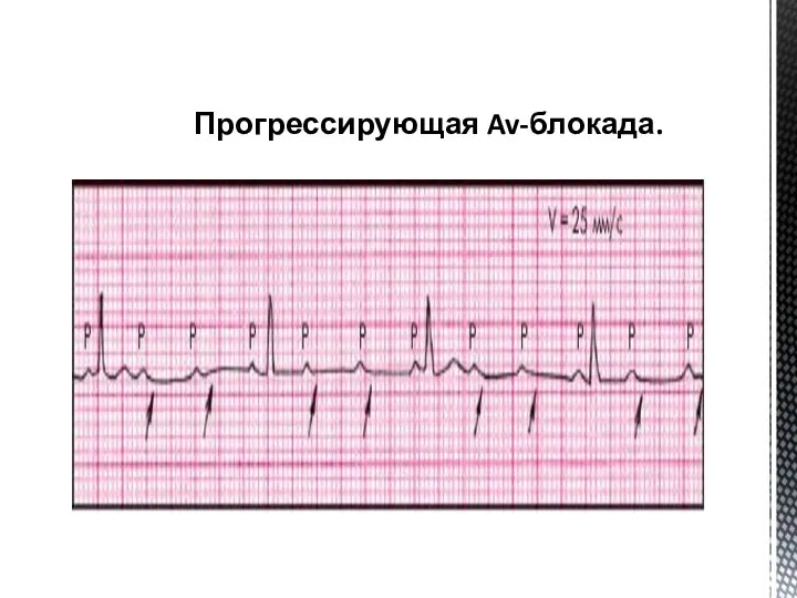 Прогрессирующая Av-блокада.