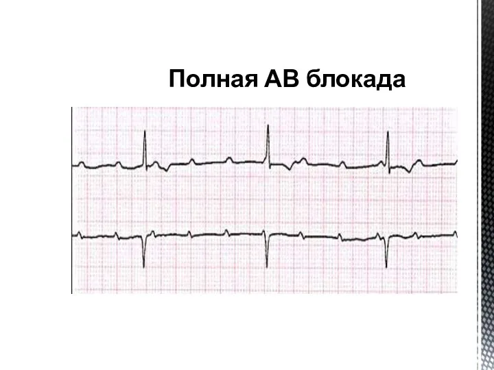 Полная АВ блокада