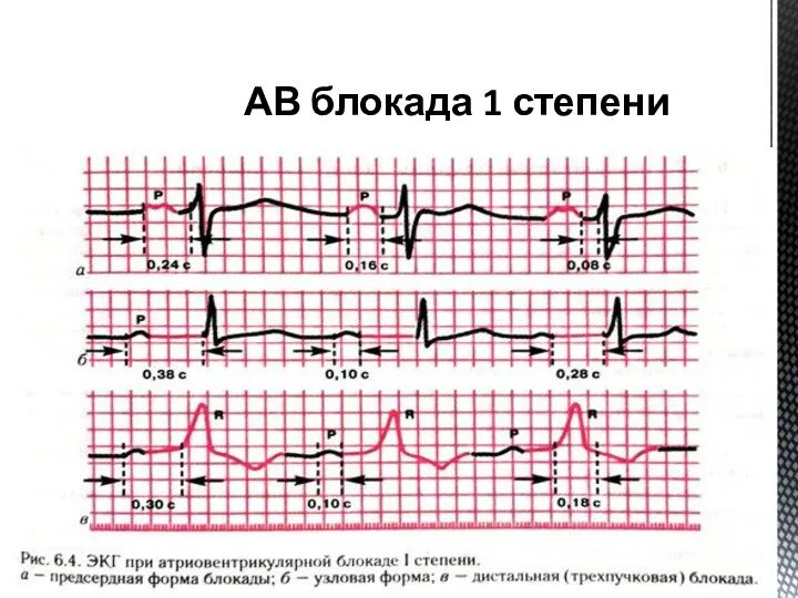 АВ блокада 1 степени