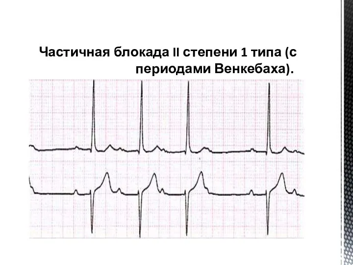 Частичная блокада II степени 1 типа (с периодами Венкебаха).