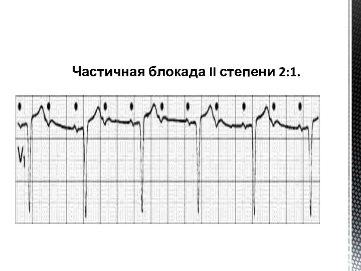 Частичная блокада II степени 2:1.