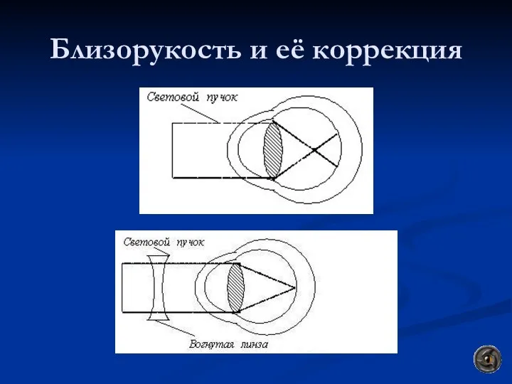 Близорукость и её коррекция