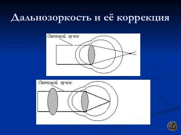 Дальнозоркость и её коррекция