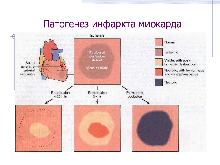 Патогенез инфаркта миокарда