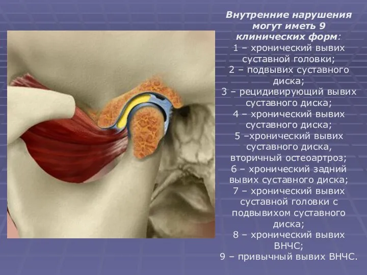 Внутренние нарушения могут иметь 9 клинических форм: 1 – хронический вывих суставной