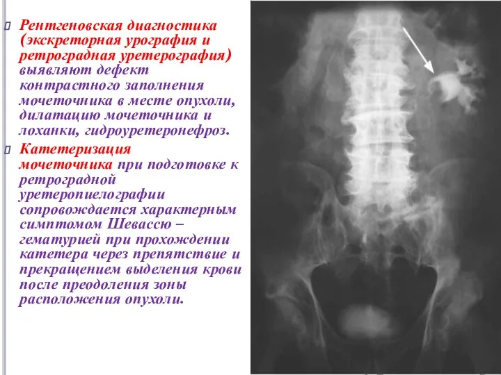 Рентгеновская диагностика (экскреторная урография и ретроградная уретерография) выявляют дефект контрастного заполнения мочеточника