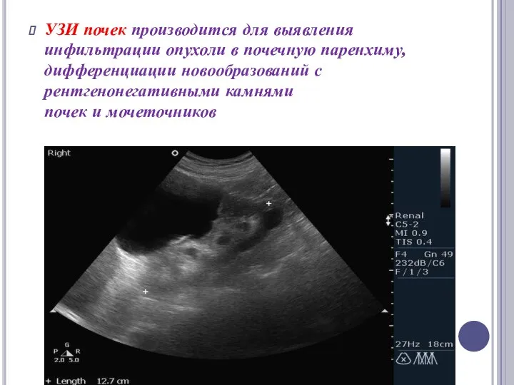 УЗИ почек производится для выявления инфильтрации опухоли в почечную паренхиму, дифференциации новообразований